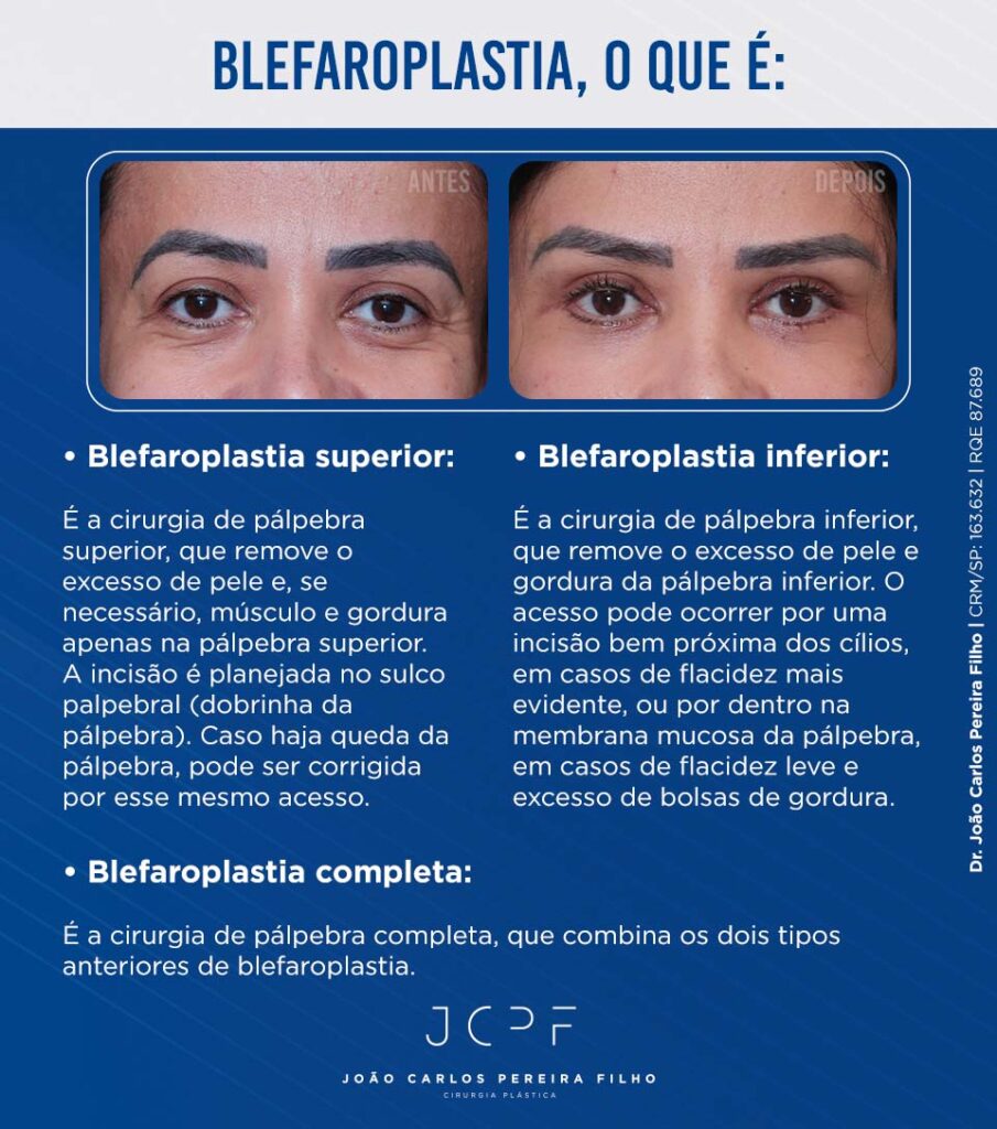 Blefaroplastia O Que Indica es E Como Feita blefaroplastia-o-que-indica-es-e-como-feita