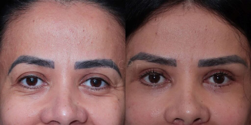 Blefaroplastia Inferior: Quando Essa Cirurgia É Indicada?